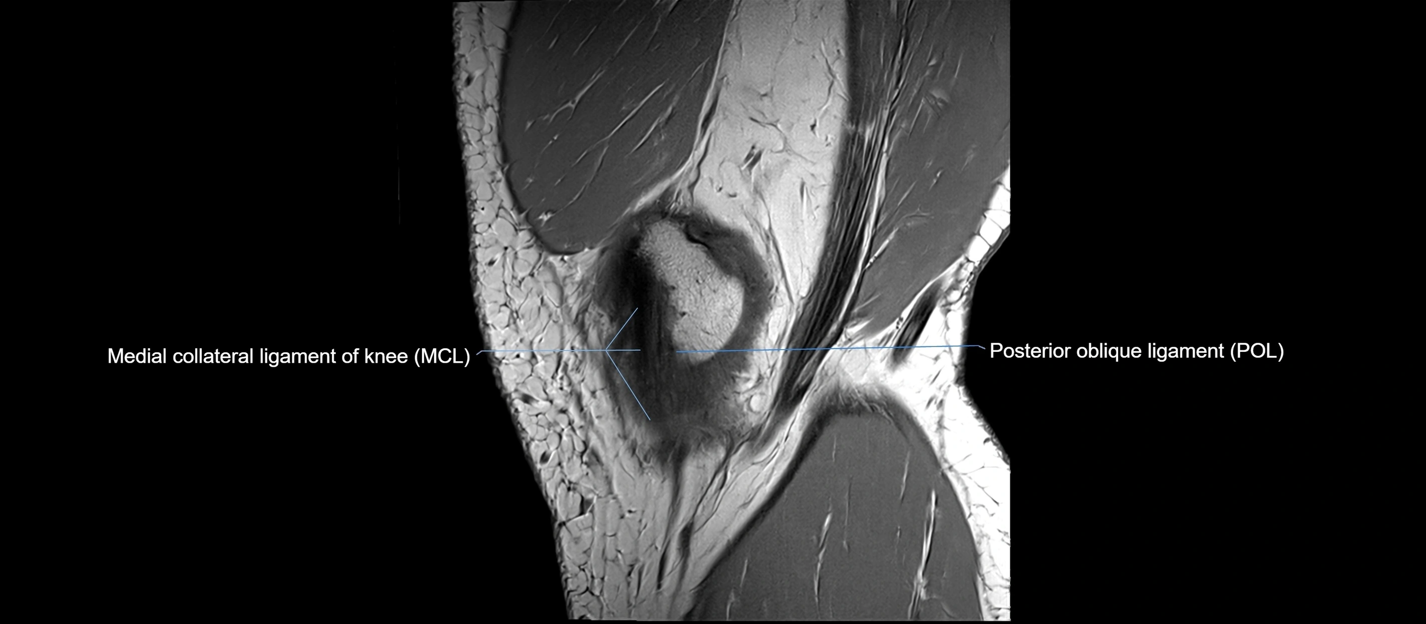 MRI sagittal  ligaments cross sectional anatomy 3T  radiology  image-img-00001-00009.webp